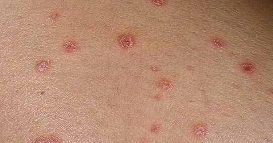 Psoriatické plaky