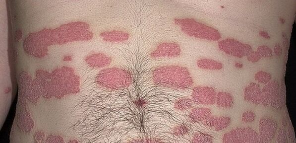 Psoriáza