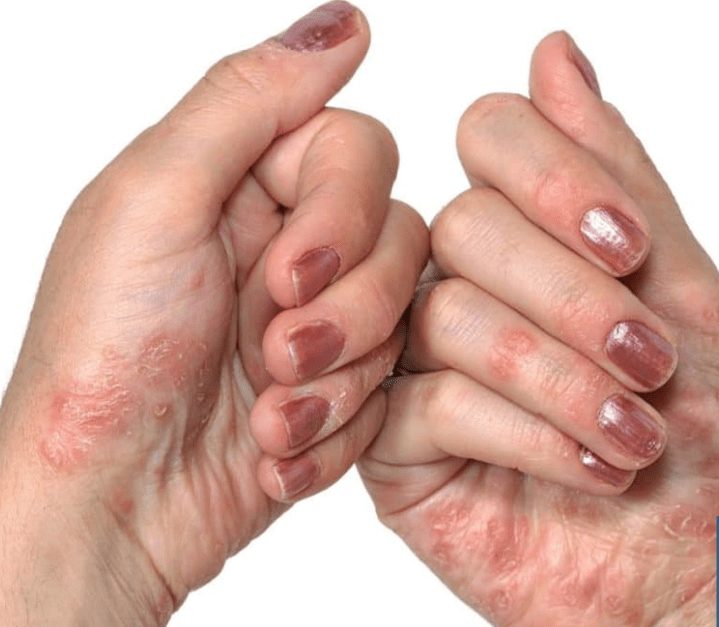 Psoriáza v rukách