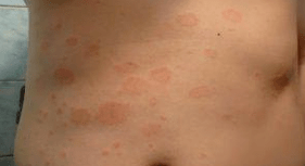Nešťastná psoriáza