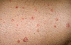 Psoriatické plaky