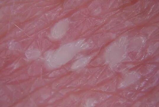 Pustulénia psoriáza