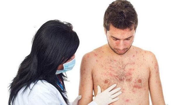 Psoriázová fotografia