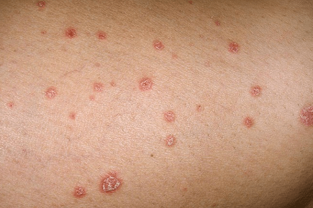 Psoriatické plaky