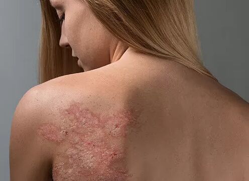 Psoriáza na chrbte dievčaťa
