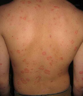 psoriáza na chrbte
