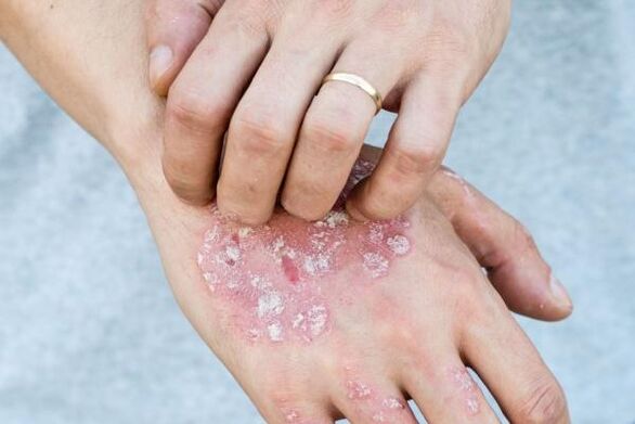 charakteristické príznaky psoriázy na rukách