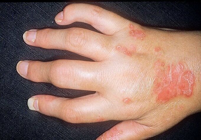psoriatická artritída na rukách