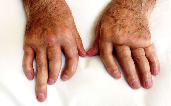 Mútiaca artritída pri psoriáze
