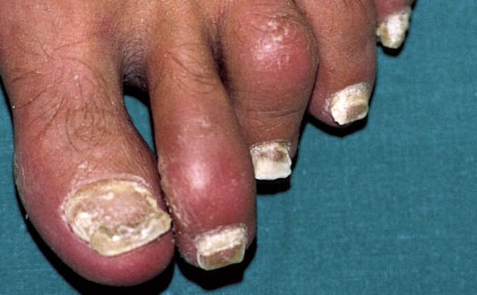Psoriáza s postihnutím nechtov a zápalom kĺbov (artritída) prstov na nohách